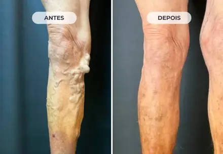 Perna antes e depois do tratamento das varizes com a Técnica ATTA, caso 1 de 6