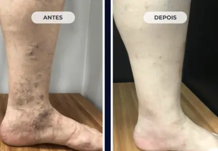 Perna antes e depois do tratamento das varizes com a Técnica ATTA, caso 3 de 6
